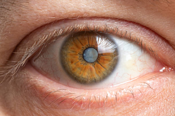 This brief guide will teach you about cataract surgery