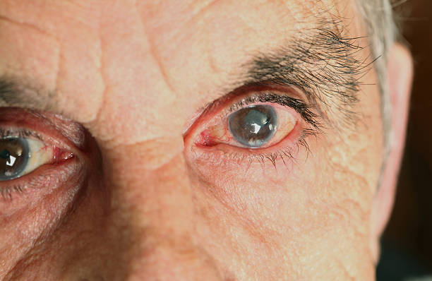 Top 5 Reasons You Cannot Avoid Cataract Surgery
