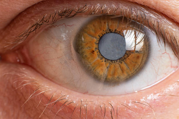 What is Cataract Surgery